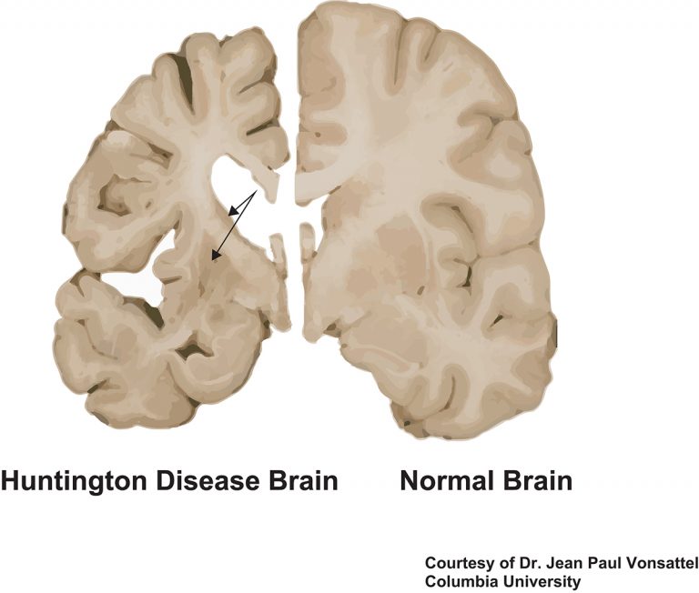 current research on huntington's disease