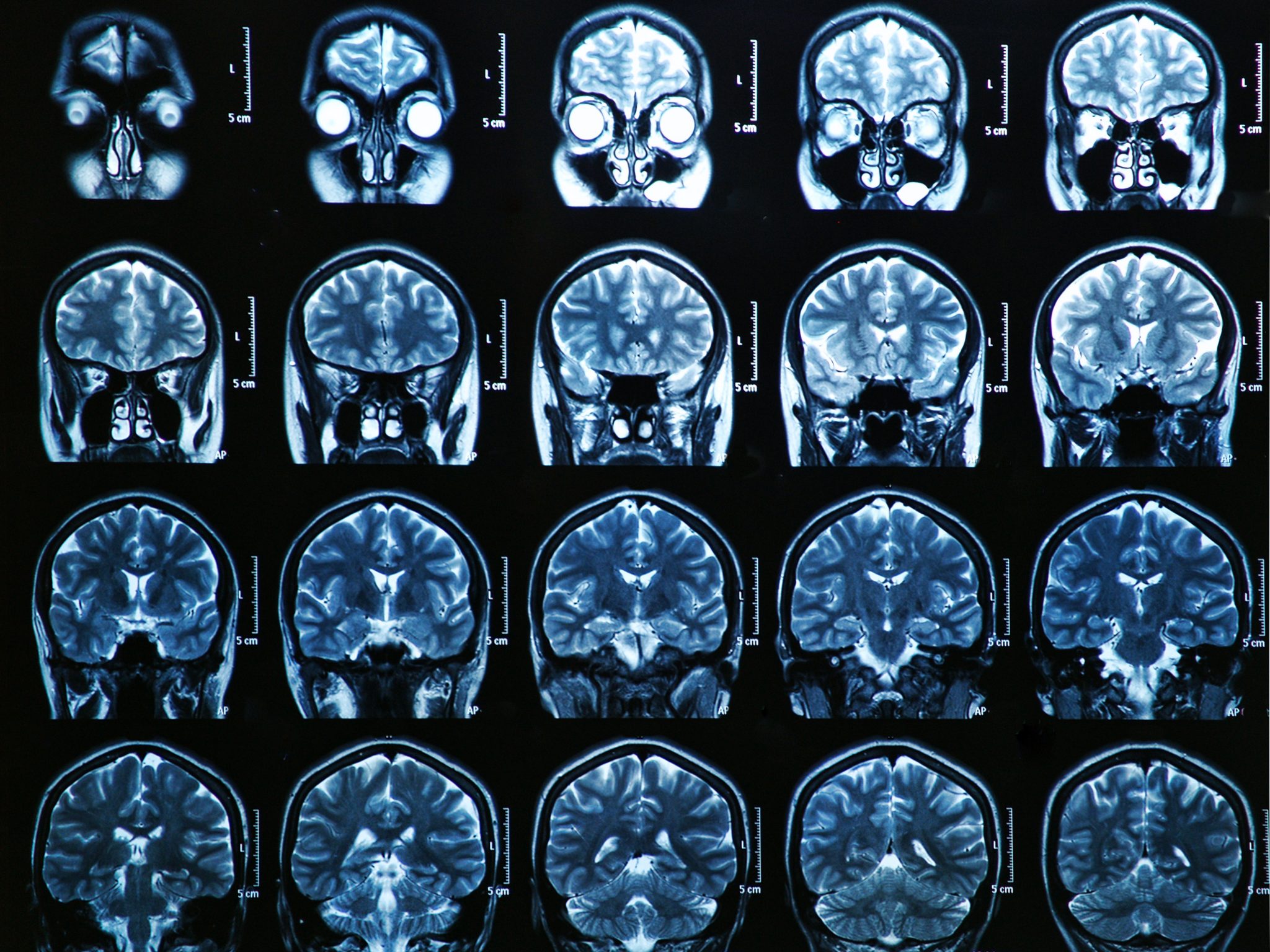 Магнитно резонансная томография головного мозга энцефалопатия