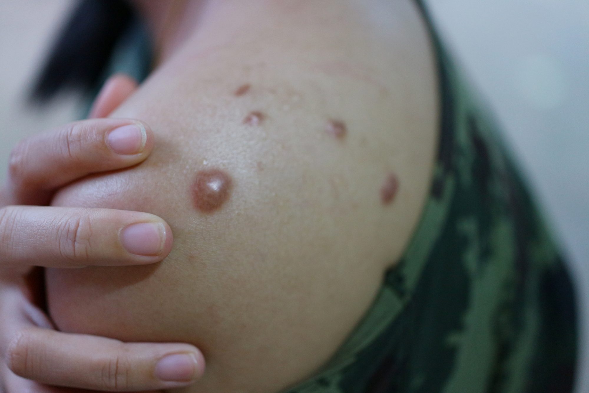 Can monkeypox cause keloid scars?