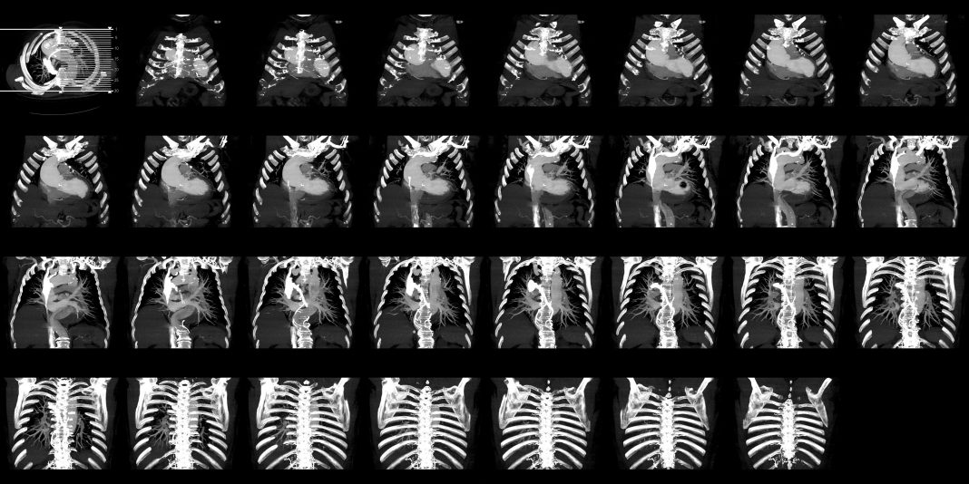 Thoracoabdominal CT