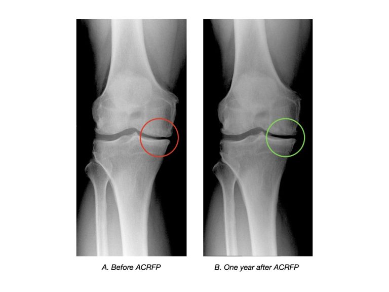 Returning to an active life with knee osteoarthritis