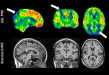 A case study of arterial spin labelling (ASL), revealing the characteristic patterns of Alzheimer’s disease (shown with white arrows). The image is similar to what would be obtained with a PET scan (not shown); conversely, a standard MRI of the same patient does not yet show sufficient abnormality to make a diagnosis.