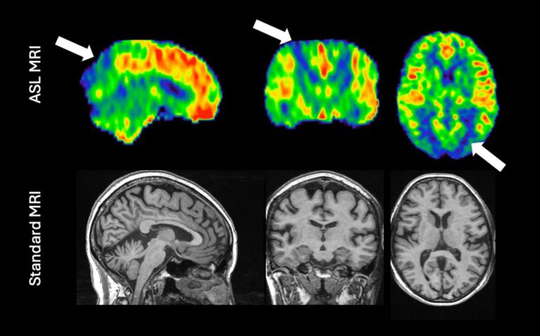 A case study of arterial spin labelling (ASL), revealing the characteristic patterns of Alzheimer’s disease (shown with white arrows). The image is similar to what would be obtained with a PET scan (not shown); conversely, a standard MRI of the same patient does not yet show sufficient abnormality to make a diagnosis.