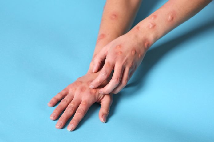 Woman with rash suffering from monkeypox virus