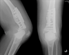 Figure 1: After the infection, the original artificial joint has been removed and replaced with a gap filled with antibiotic-infused bone cement, rendering the joint completely non-weight-bearing and immobile, with two securing steel plates.