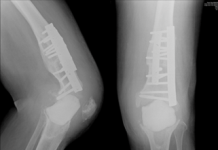 Figure 4-11: After the infection, the original artificial joint has been removed and replaced with a gap filled with antibiotic-infused bone cement, rendering the joint completely non-weight-bearing and immobile, with two securing steel plates.