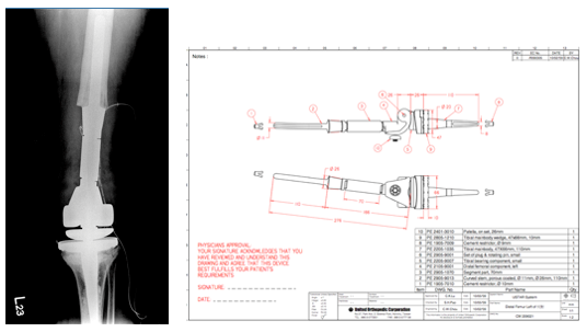 Figure 4-12: With the bones around the patient's joint severely damaged to the extent that common artificial joint models could not be fitted, following extensive collaboration with engineers, we decided to design and customize a long-stem artificial joint, significantly enhancing the success rate of treatment and the patient's quality of life. 