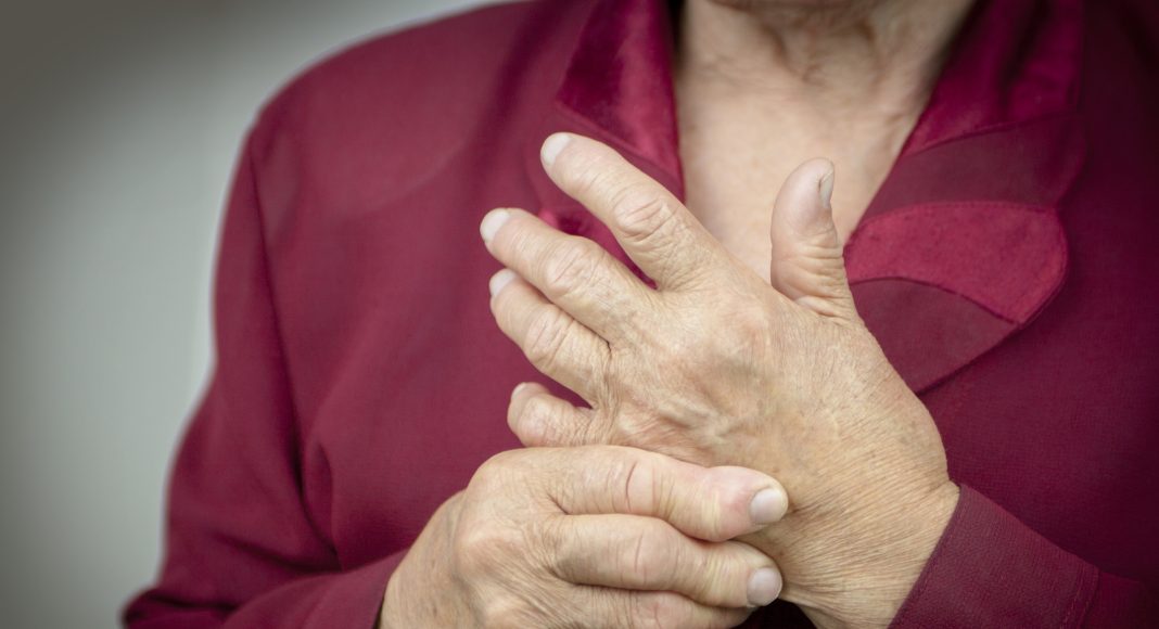 Hands Of Woman Deformed From Rheumatoid Arthritis. PainRheumatoid arthritis hands. MacroRheumatoid arthritis hands. Macro