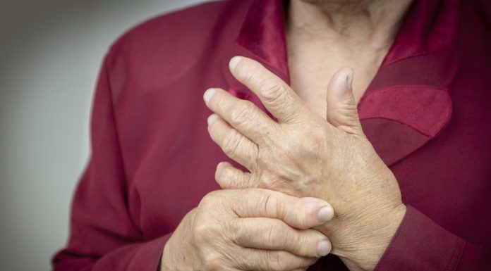 Hands Of Woman Deformed From Rheumatoid Arthritis. PainRheumatoid arthritis hands. MacroRheumatoid arthritis hands. Macro