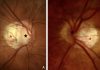 Figure 1. photo of a peripapillary intrachoroidal cavitation. The crescent-shaped atrophic area (red star), at the border of the optic nerve head (black star), called myopic conus, is alone in (A). It presents a circumscribed, yellow-orange lesion (white star) at its outer border in (B), corresponding to the peripapillary intrachoroidal cavitation. Note: Figures 1 and 2 are reprinted from Peripapillary Intrachoroidal Cavitation. Adèle Ehongo et al. ‘J. Clin. Med. 2023, 12, 4712’ Originally published by and used with permission from MDPI.