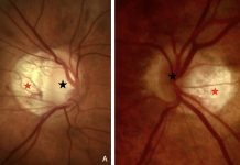 Figure 1. photo of a peripapillary intrachoroidal cavitation. The crescent-shaped atrophic area (red star), at the border of the optic nerve head (black star), called myopic conus, is alone in (A). It presents a circumscribed, yellow-orange lesion (white star) at its outer border in (B), corresponding to the peripapillary intrachoroidal cavitation. Note: Figures 1 and 2 are reprinted from Peripapillary Intrachoroidal Cavitation. Adèle Ehongo et al. ‘J. Clin. Med. 2023, 12, 4712’ Originally published by and used with permission from MDPI.