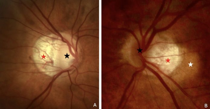 Figure 1. photo of a peripapillary intrachoroidal cavitation. The crescent-shaped atrophic area (red star), at the border of the optic nerve head (black star), called myopic conus, is alone in (A). It presents a circumscribed, yellow-orange lesion (white star) at its outer border in (B), corresponding to the peripapillary intrachoroidal cavitation. Note: Figures 1 and 2 are reprinted from Peripapillary Intrachoroidal Cavitation. Adèle Ehongo et al. ‘J. Clin. Med. 2023, 12, 4712’ Originally published by and used with permission from MDPI.