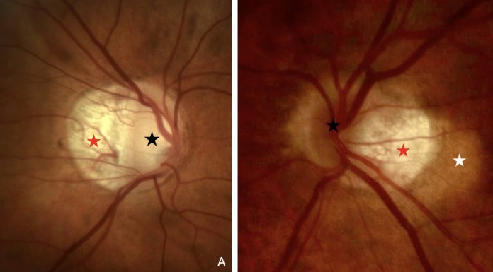 Figure 1. photo of a peripapillary intrachoroidal cavitation. The crescent-shaped atrophic area (red star), at the border of the optic nerve head (black star), called myopic conus, is alone in (A). It presents a circumscribed, yellow-orange lesion (white star) at its outer border in (B), corresponding to the peripapillary intrachoroidal cavitation. Note: Figures 1 and 2 are reprinted from Peripapillary Intrachoroidal Cavitation. Adèle Ehongo et al. ‘J. Clin. Med. 2023, 12, 4712’ Originally published by and used with permission from MDPI.