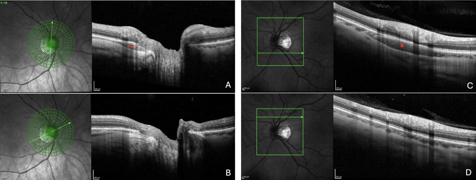 Figure 2.OCT features of peripapillary intrachoroidal cavitation. For each section, the green arrow in the infrared image indicates the location of the corresponding slice. The arrowhead indicates the right side of the OCT section.Two radial OCT slices of the same optic nerve head, with (A) and without (B) a peripapillary intrachoroidal cavitation (PICC). The PICC appears as a triangular hyporeflective intrachoroidal thickening (red star) with its base at the ONH. Two linear OCT slices of the same eye with (C) and without (D) PICC. The PICC appears as a hyporeflective intrachoroidal thickening (red star) without modification of the plane of the anterior structures.