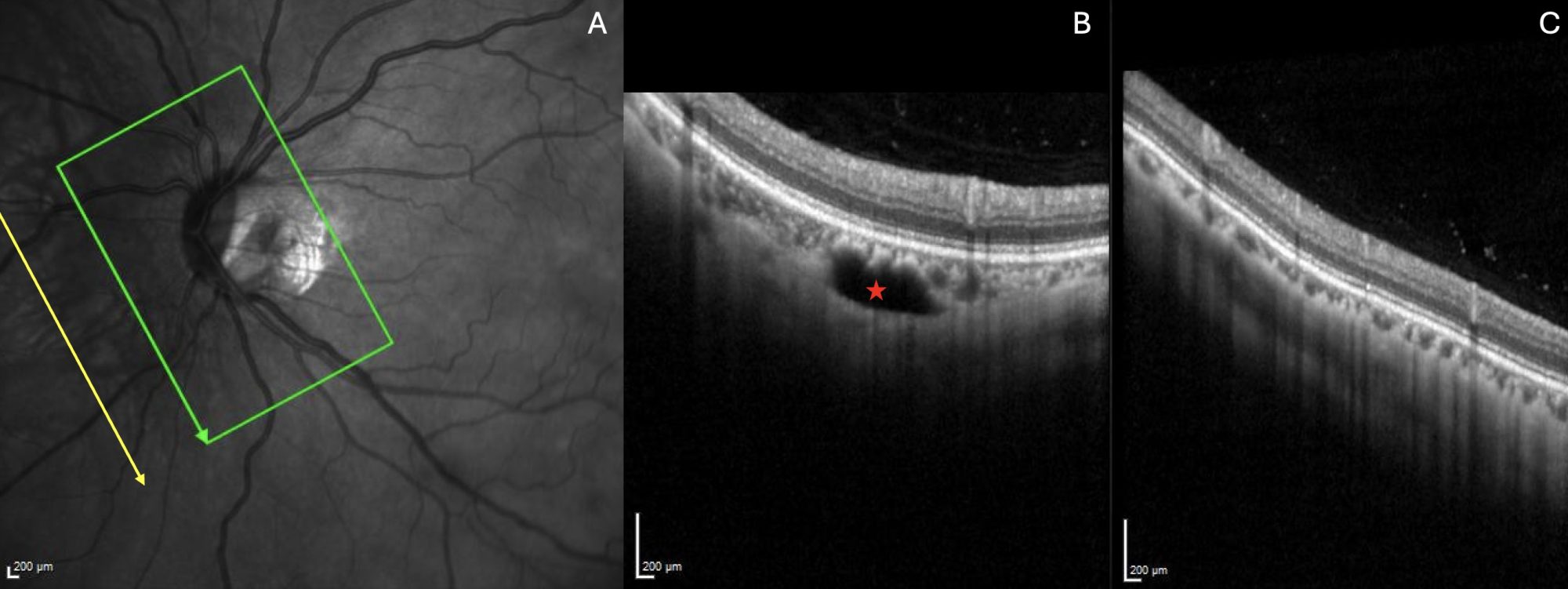 Figure 3. PICC is a suprachoroidal detachment. The green and yellow arrows on the infrared image (A) indicate the location of sections (B) with PICC (red star), and (C) without PICC respectively. PICC clearly appears as a suprachoroidal detachment in (B).Note: Reprinted from Analysis of Peripapillary Intrachoroidal Cavitation and Myopic Peripapillary Distortions in Polar Regions by Optical Coherence Tomography. Adèle Ehongo et al. ‘Clinical Ophthalmology 2022:16 2617-2629’ Originally published by and used with permission from Dove Medical Press Ltd.’