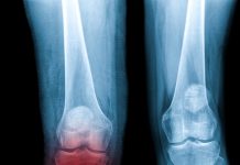 X-ray Knee Joint Fracture proximal tibia and Post fix fracture proximal tibia with plate and screws, highlighted in red