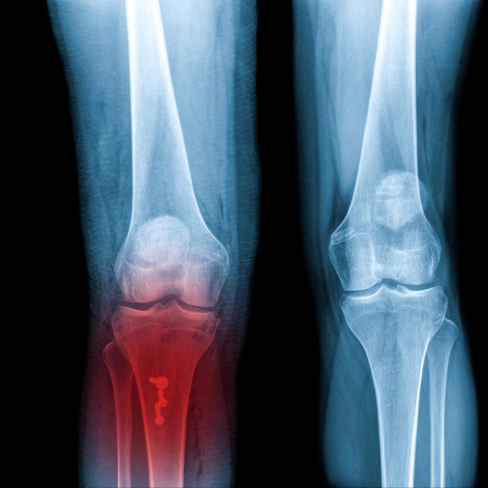 X-ray Knee Joint Fracture proximal tibia and Post fix fracture proximal tibia with plate and screws, highlighted in red