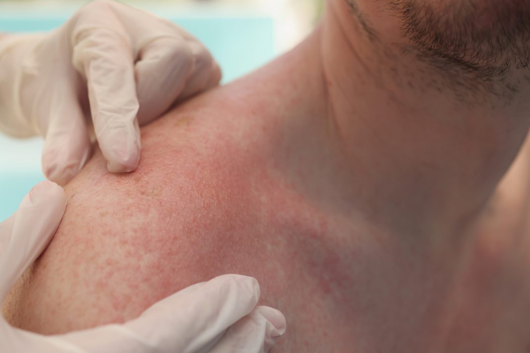 The doctor's hands touch the burn on the man's shoulders, close-up. Allergy to the sun, dermatological diseases