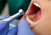 Close up of a professional dental brushing at the clinic