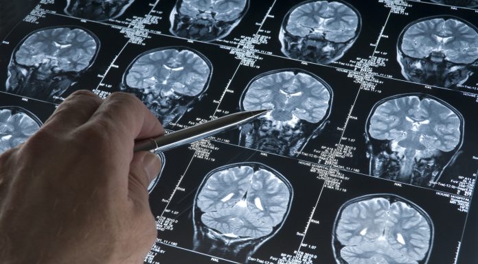 MRI Brain Scan of head and skull with hand pointing