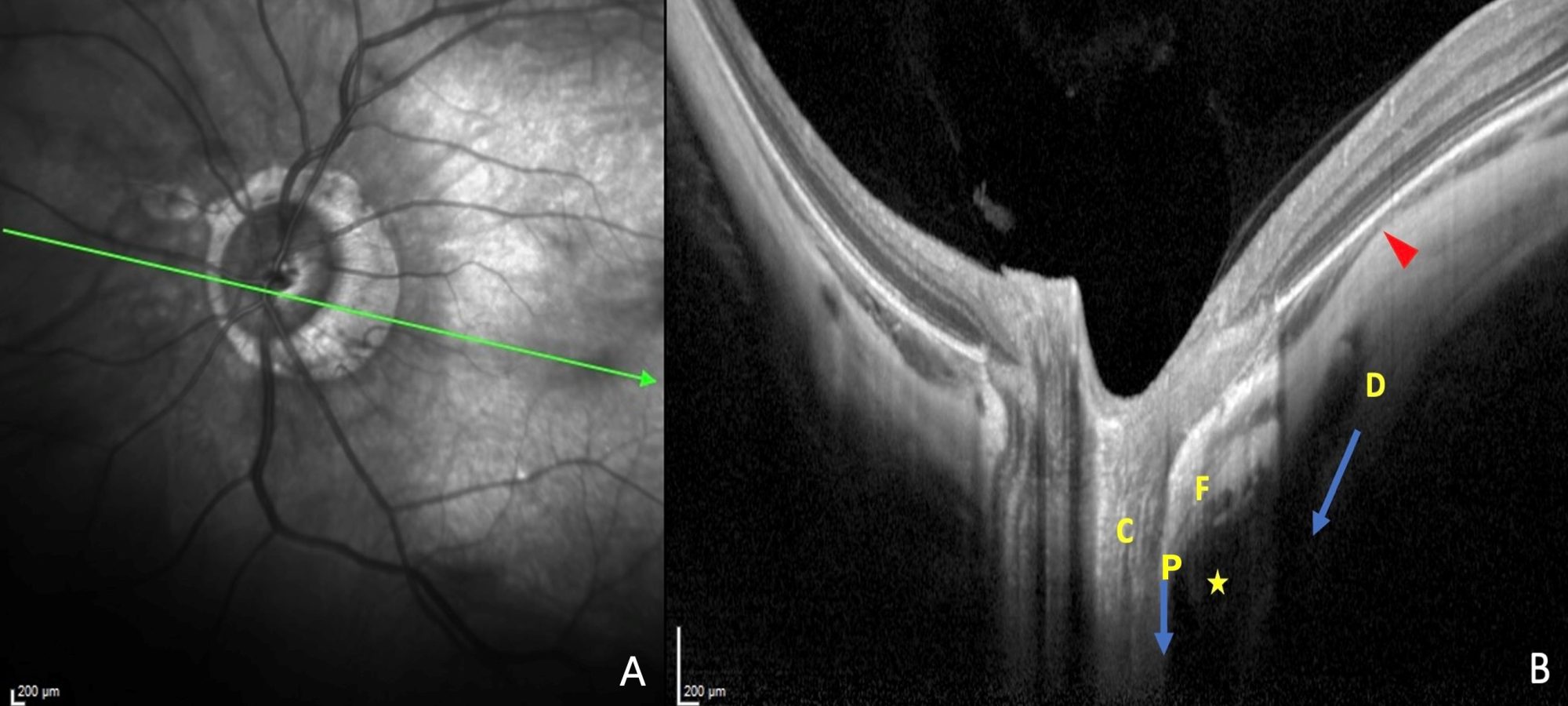 Figure 2. Pathogenetic hypothesis of peripapillary staphyloma (PPS). (A) The green arrow in the infrared image indicates the location of theOCT section. (B) The PPS is characterized by a gradual thinning of the choroid from the periphery towards the PPS edge (red arrowhead) and a gradual re-thickening of the choroid from the PPS edge towards the optic nerve and along an outwards scleral deformation. The direct posterior traction (blue arrows) exerted by the scleral insertions of the optic nerve sheaths would lead to the outpouching of the sclera while the thinning of the choroid at the PPS edge would result from the squeezing of the eyeball by the tangential component (red arrowhead) of this traction force. Abbreviation: D= dura; P = pia mater; F = Scleral flange; C = Lamina cribrosa; Yellow star = Subarachnoid space. The device used is the Spectral Domain OCT Spectralis® HRA-OCT, model S3300 (Heidelberg Engineering GmbH, Heidelberg Germany). Note: Reprinted from Understanding Posterior Staphyloma in Pathologic Myopia: Current Overview, New Input, and Perspectives. Adèle Ehongo. ‘Clinical Ophthalmology Clin 2023: 17:3825-3853’ Originally published by and used with permission from Dove Medical Press Ltd.