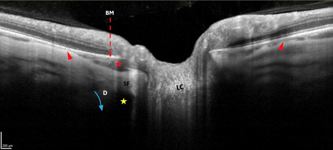 Figure 1. Landmarks of the peripapillary intrachoroidal cavitation (PICC). LC = lamina cribrosa. BM = Bruch’s membrane (dashed red arrow). SF = scleral flange, the sclera between the dura and the pia mater. D = dura mater. PICC (red star) is in front of the subarachnoid space (yellow star). It is a suprachoroidal detachment. It is suggested to be promoted by a direct traction force (blue arrow) of the dura mater during eye movements. A tangential component of this traction force squeezes the choroid at the end of the posterior outpouching (red arrowheads). The device used is the Spectral Domain OCT Spectralis® HRA-OCT, model S3300 (Heidelberg Engineering GmbH, Heidelberg Germany). Note: Reprinted from Peripapillary Intrachoroidal Cavitation. Adèle Ehongo et al. ‘J. Clin. Med. 2023, 12, 4712’ Originally published by and used with permission from MDPI.