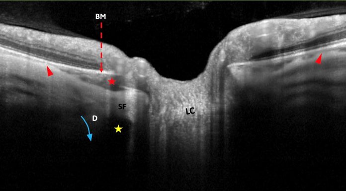 Figure 1. Landmarks of the peripapillary intrachoroidal cavitation (PICC). LC = lamina cribrosa. BM = Bruch’s membrane (dashed red arrow). SF = scleral flange, the sclera between the dura and the pia mater. D = dura mater. PICC (red star) is in front of the subarachnoid space (yellow star). It is a suprachoroidal detachment. It is suggested to be promoted by a direct traction force (blue arrow) of the dura mater during eye movements. A tangential component of this traction force squeezes the choroid at the end of the posterior outpouching (red arrowheads). The device used is the Spectral Domain OCT Spectralis® HRA-OCT, model S3300 (Heidelberg Engineering GmbH, Heidelberg Germany). Note: Reprinted from Peripapillary Intrachoroidal Cavitation. Adèle Ehongo et al. ‘J. Clin. Med. 2023, 12, 4712’ Originally published by and used with permission from MDPI.