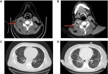 Figure 2: Radiographic response imaging to pralsetinib plus lorlatinib. (A) Computed tomography (CT) during lorlatinib treatment revealing right cervical lymph node. (B) CT showing decrease in lymph node size with necrosis after addition of pralsetinib. (C) Chest CT during lorlatinib treatment showing right-sided pleural effusion. (D) Chest CT showing decrease in effusion after pralsetinib treatment. Images A and C were taken on day 1135 post-diagnosis. Images B and D were taken on day 1268. Credit Copyright: © 2025 Wu and Iams.