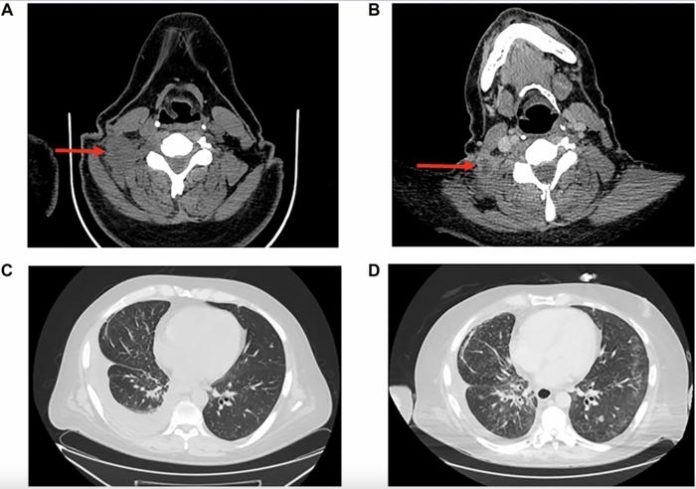 Figure 2: Radiographic response imaging to pralsetinib plus lorlatinib. (A) Computed tomography (CT) during lorlatinib treatment revealing right cervical lymph node. (B) CT showing decrease in lymph node size with necrosis after addition of pralsetinib. (C) Chest CT during lorlatinib treatment showing right-sided pleural effusion. (D) Chest CT showing decrease in effusion after pralsetinib treatment. Images A and C were taken on day 1135 post-diagnosis. Images B and D were taken on day 1268. Credit Copyright: © 2025 Wu and Iams.