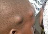 Worm nodules containing Onchocerca volvulus, the filarial species causing river blindness if not treated, on the head of a 5 year-old boy