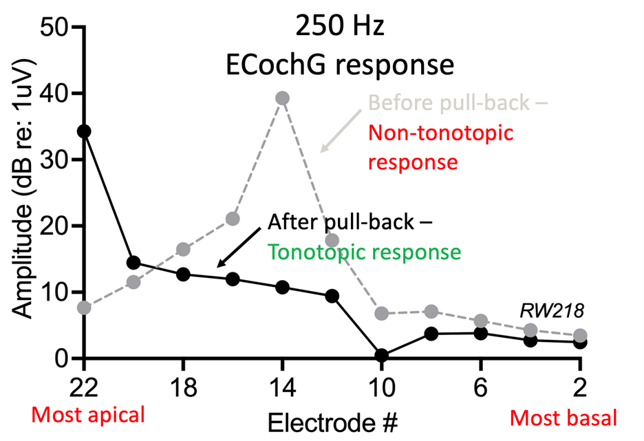 Figure 2: Electrocochleography-guided pullback can potentially optimize the tonotopic response, especially when the response is non-tonotopic after the initial insertion.